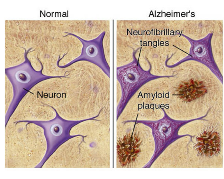 featured image thumbnail for post Opening Pathways in the Treatment of Alzheimer’s Disease (Advanced Read)